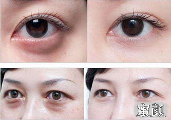 科技揭秘，最新去眼袋最佳方法，重塑眼部美麗新篇章！